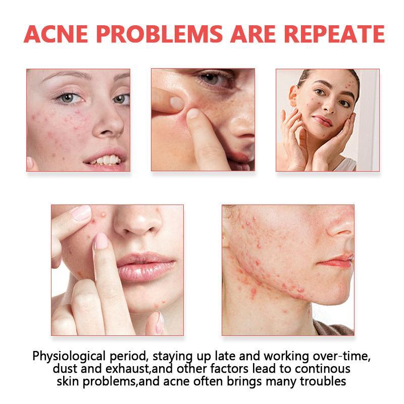 แผ่นแปะสิวแบบไฮโดรคอลลอยด์ ปิด - Skincare Oil Control บทวิจารณ์และราคา